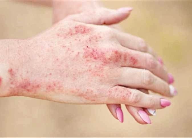 Watch out for these signs of the Lupus disease