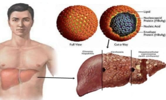 World Hepatitis Day: Expert explains major routes of transmission
