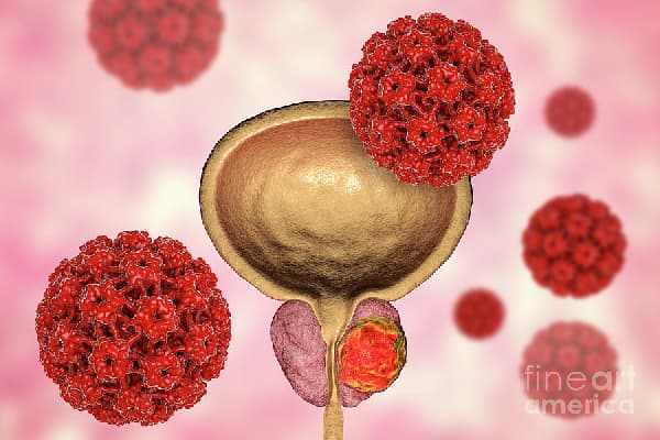 ‎Early detection key to reducing prostate cancer deaths – Urologist‎