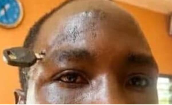 Doctors successfully remove motorbike key from farmer’s skull