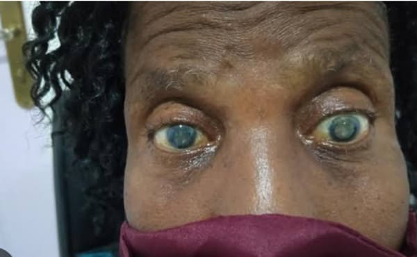Cataracts account for more than half of blindness in ghana - GHS