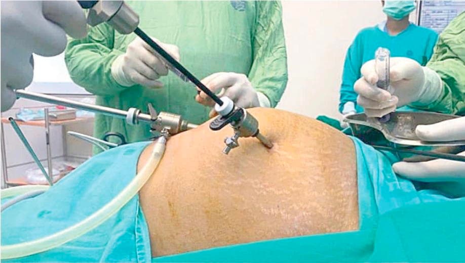 Beyond Surgery: Can nutrition and lifestyle help prevent uterine fibroids?