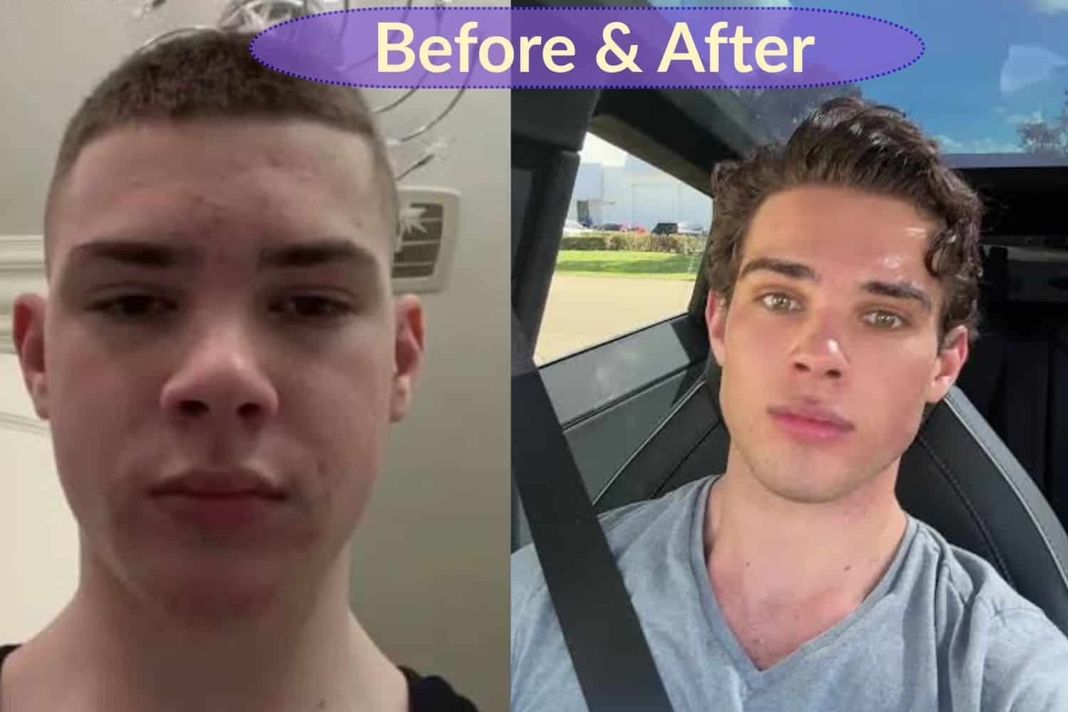 The dangers of looksmaxxing: Why young men are risking everything for the perfect face