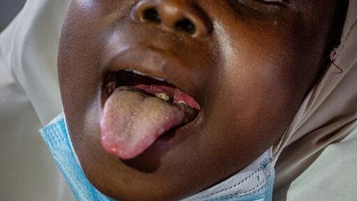 Taraba begins tetanus-diphtheria vaccination for women