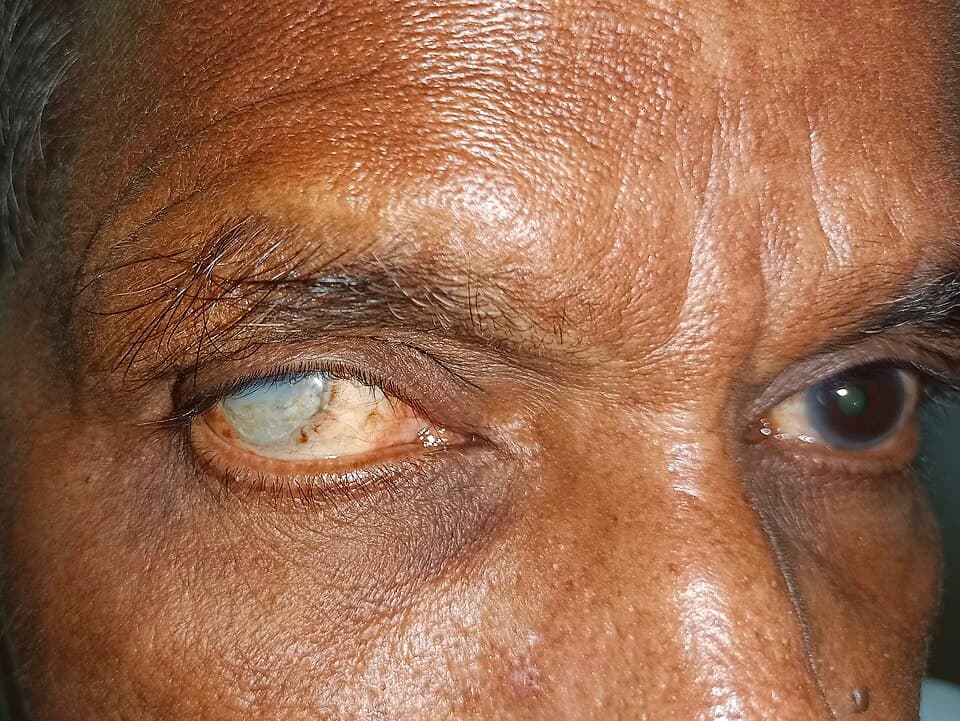 Cataracts drive avoidable blindness in over two million Nigerians – Ophthalmologist