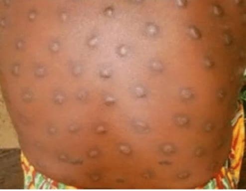 Asukawkaw communities record increase in blackfly bites 