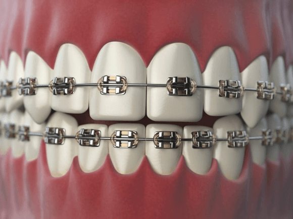 Braces beyond treatment: Gen Z’s fashion craze and the hidden dental risks