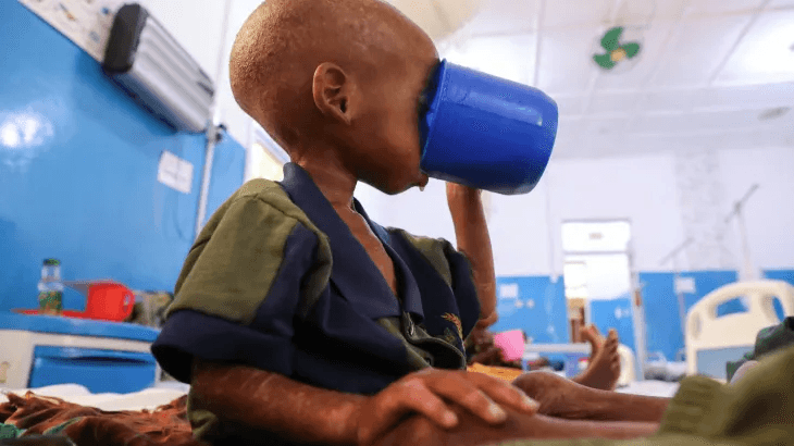 Somalia child hunger crisis deepens after aid cuts, UNICEF says