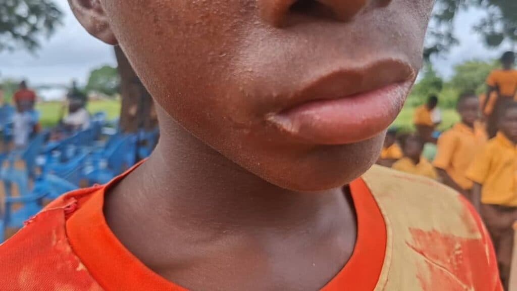 Mysterious illness leaves children struggling to walk, hear as Mafi Kope community appeals for urgent medical help