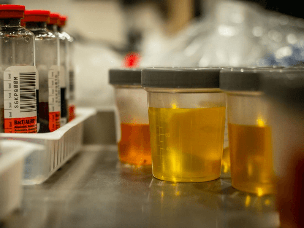 Urine test can spot more than nine in 10 bladder cancers
