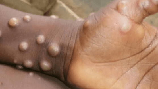 Mpox: Benue investigates suspected cases in Konshisha LG