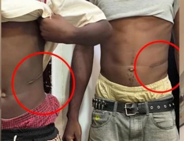 N1.5m for kidney: Lawyer alleges illegal organ harvest in Abuja