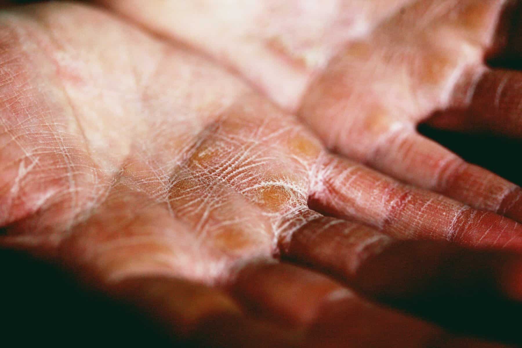 Dry skin not going away? There may be more to it than a change of season